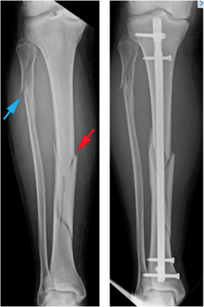 Tibia Fracture | Orthopedic Centers of Colorado